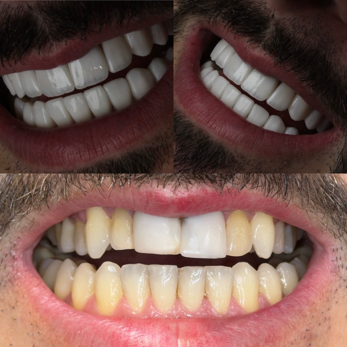 Antes e Depois 3