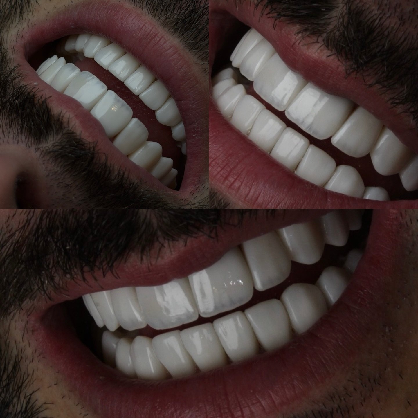Antes e Depois 1